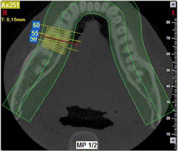 Hochmoderne 3D-Diagnostik in Kassel zur millimetergenauen Planung von Zahnimplantaten.