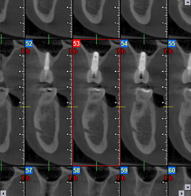 Detaillierte Darstellung verschiedener Knochenquerschnitte für eine sichere Chirurgie in Kassel.