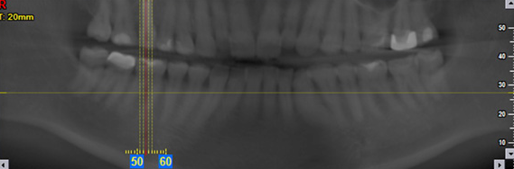 Digitale Panorama-Übersichtsaufnahme des Gebisses zur Befundung durch den Zahnarzt.
