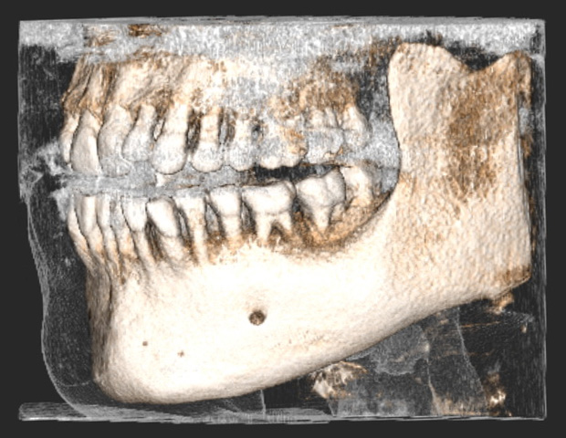 Dreidimensionale Ansicht der Kieferstruktur – moderne 3D-Diagnostik für Patienten in unserer Praxis in Kassel.