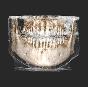 Anschauliche 3D-Rekonstruktion des Schädels durch ein DVT-Gerät, wie es beim Zahnarzt für komplexe Fälle genutzt wird.