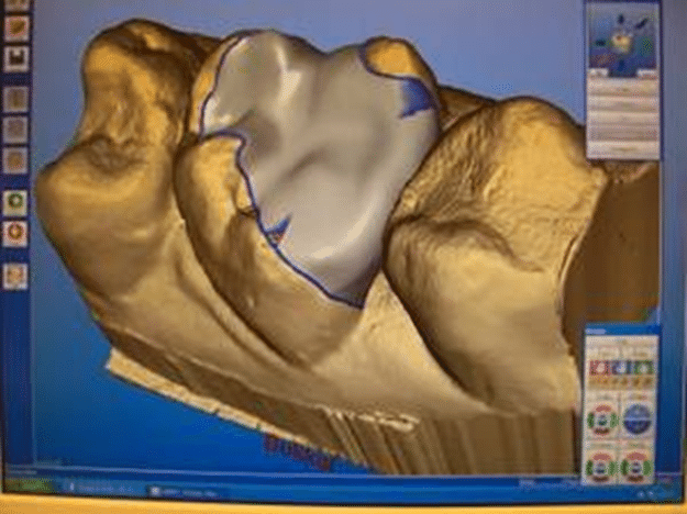 3D-Rekonstruktion eines Keramikinlays am Computerbildschirm in der Zahnarztpraxis Dr. Kollmar Kassel.