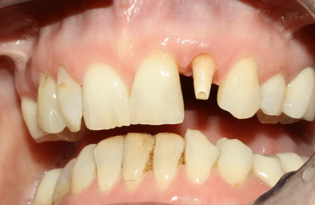 Vorbereitung für eine Vollkeramikkrone im Oberkiefer bei einem Patienten in unserer Kasseler Praxis.