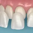 Illustration von hauchdünnen Keramik-Veneers, die für ein ästhetisches Lächeln in Kassel auf die Frontzähne gesetzt werden.